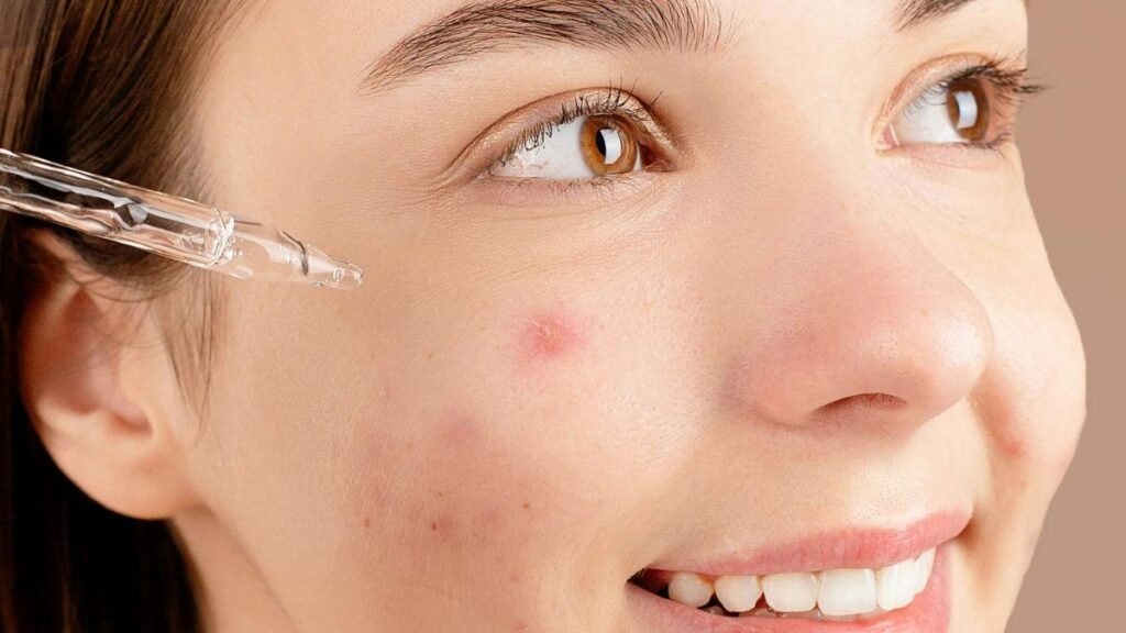 acne